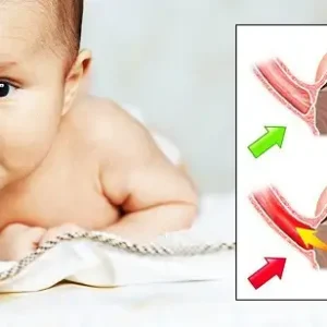 راههای درمان رفلاکس معده در نوزادان