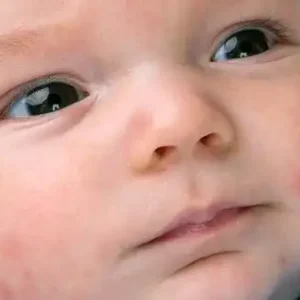 علت جوش زدن صورت نوزاد